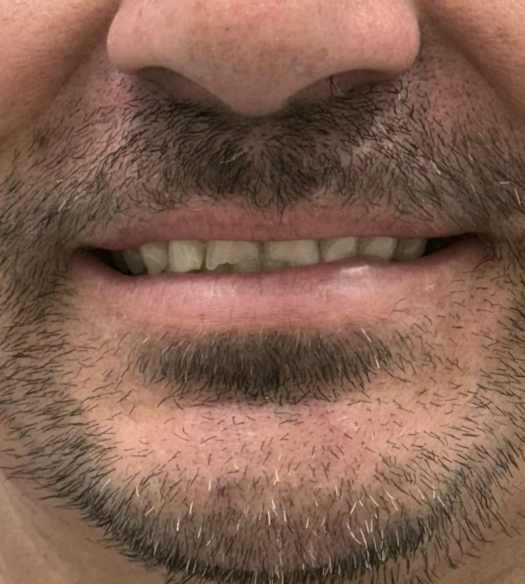 A GLOW DNTL patient's smile before full mouth rehabilitation